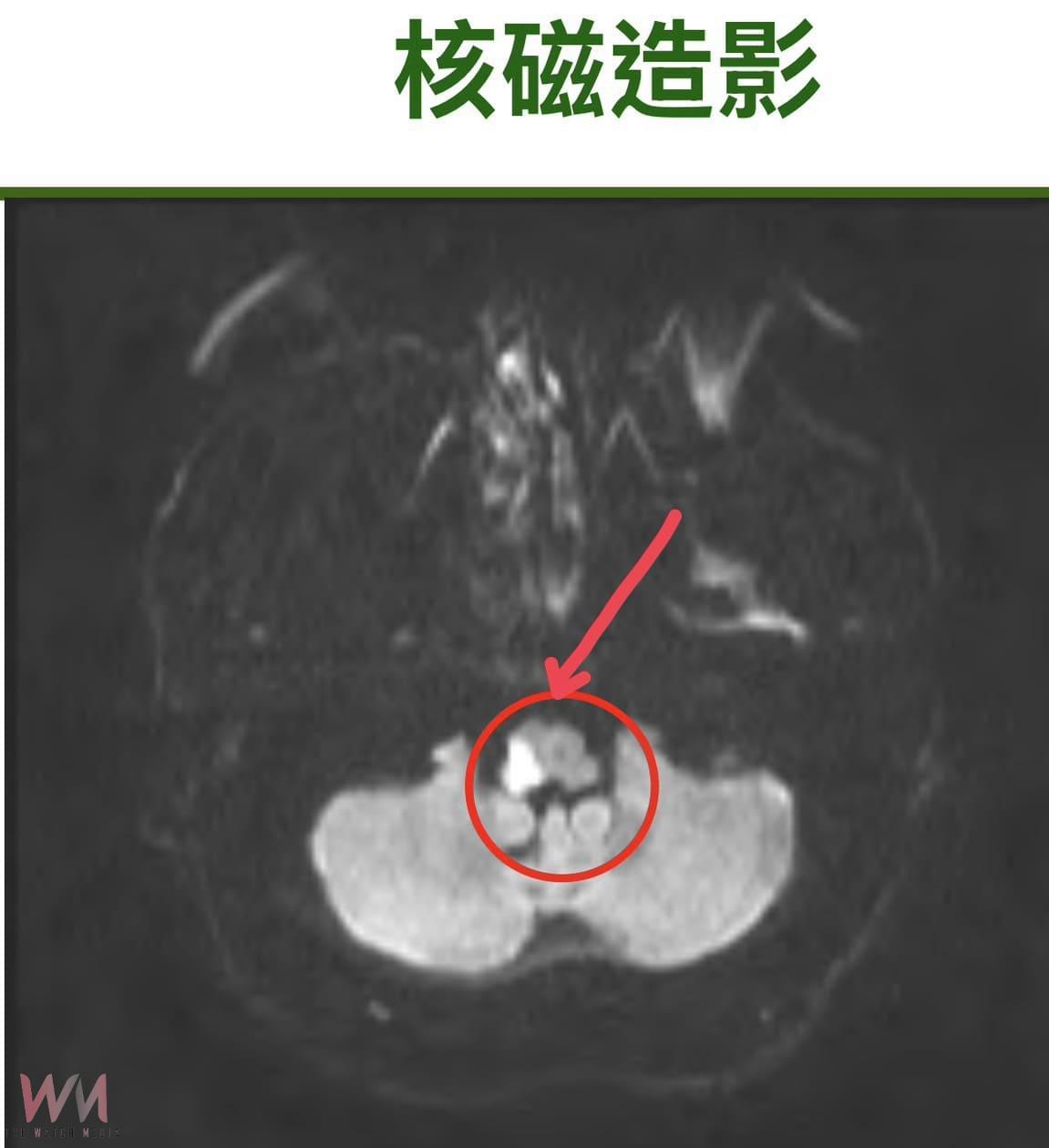 走路突然頭暈走不穩　檢查竟是腦幹中風 接受「一站式治療」數月病況穩定出院 - https://www.watchmedia01.com